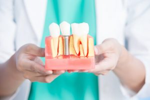 dental implant failure rates