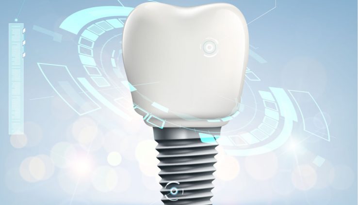 tooth implant problems