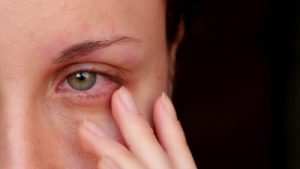 antibiotic eye drops to treat eye redness