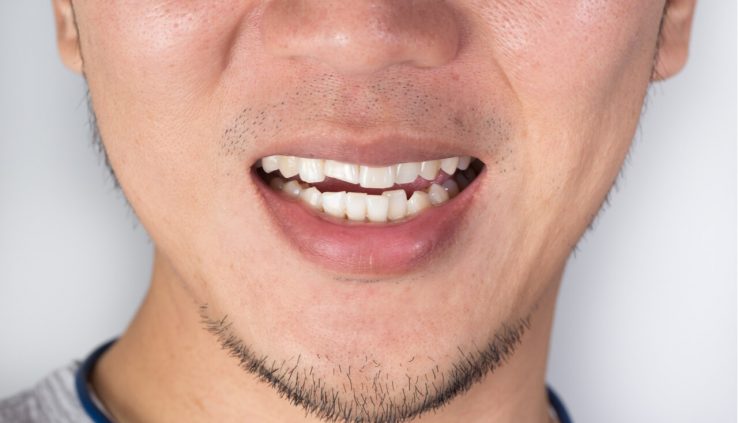 stress lines in teeth